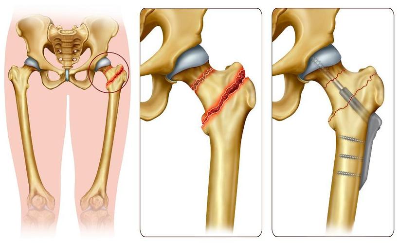 Managing vs Treating a Femoral Neck Fracture: What's Your Best Option?